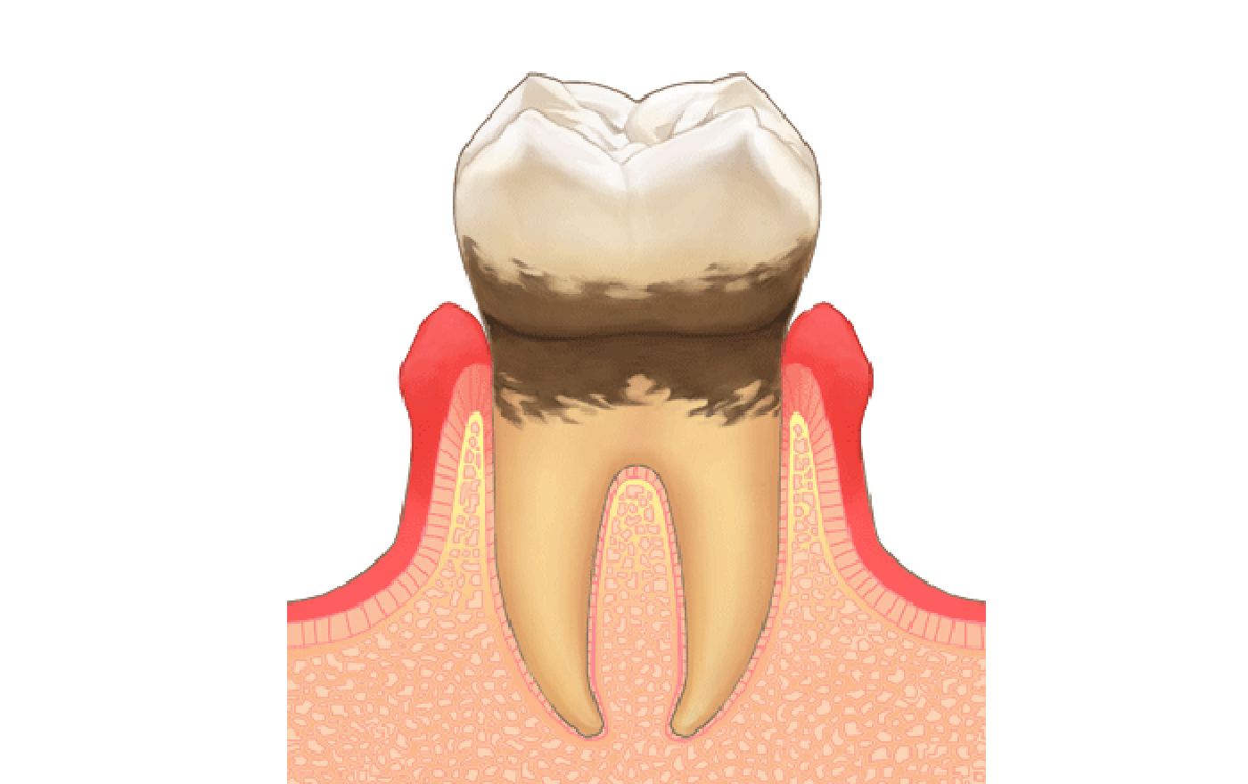 軽度歯周病
