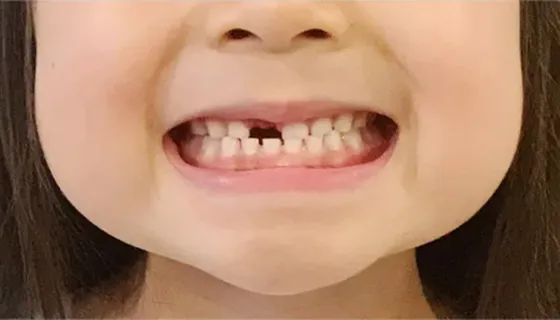 奥歯でしっかり噛んで正面から上下の前歯が写るように撮影