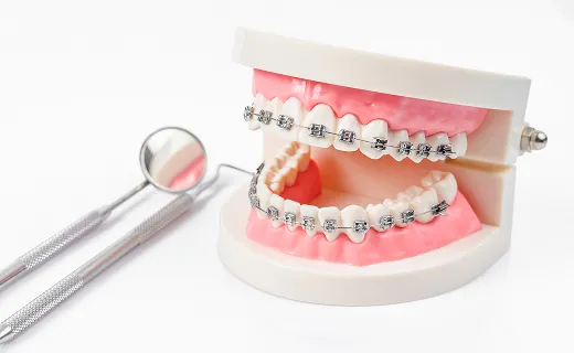 お試し矯正モニター矯正を勧めている医院に注意