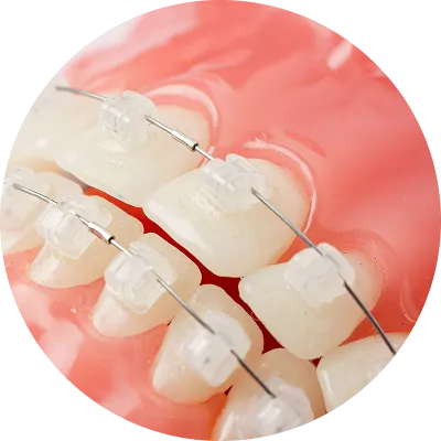 ブラケット矯正