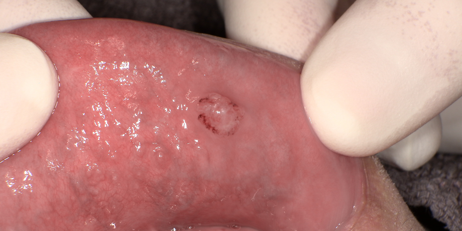 唇を噛んで、出来物が出来てしまった患者様のケース