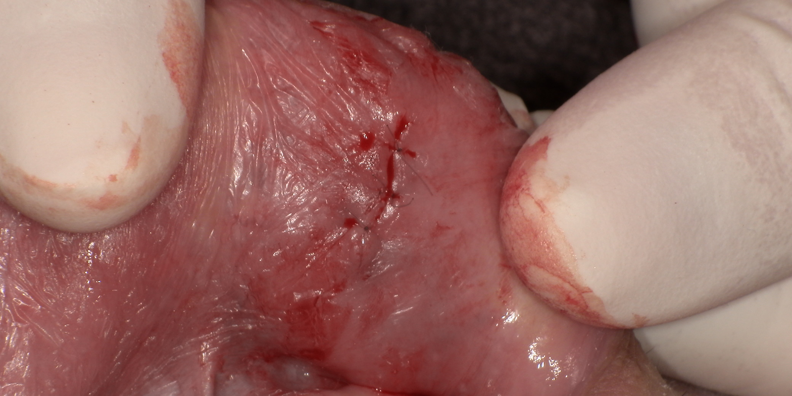 唇を噛んで、出来物が出来てしまった患者様のケース