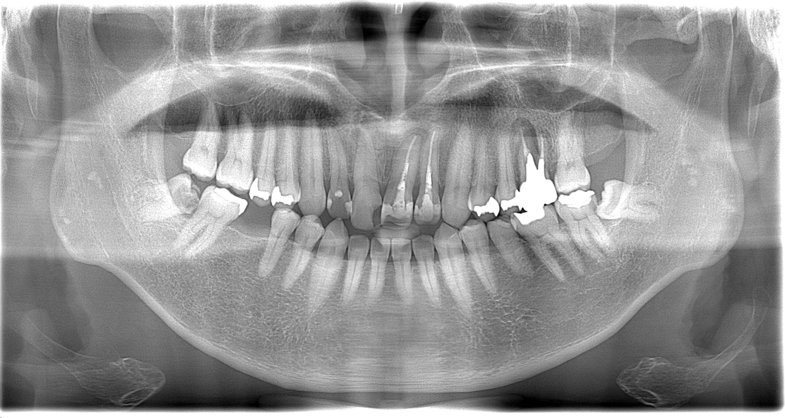 右下のインプラントのご相談