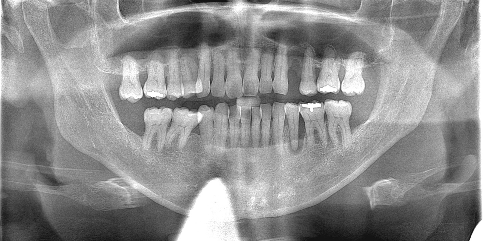 抜歯寸前の歯を救う 根管治療と歯周病治療を併用した保存治療