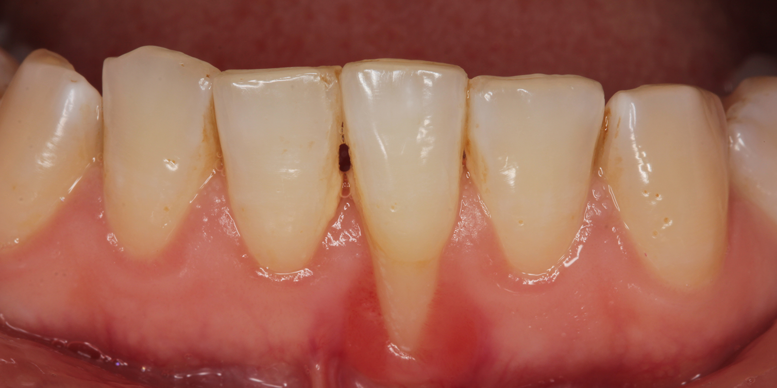 歯周病の進行プロセスと症状の変化