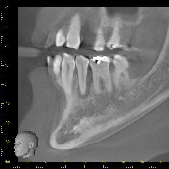 CT画像で見る骨の状態