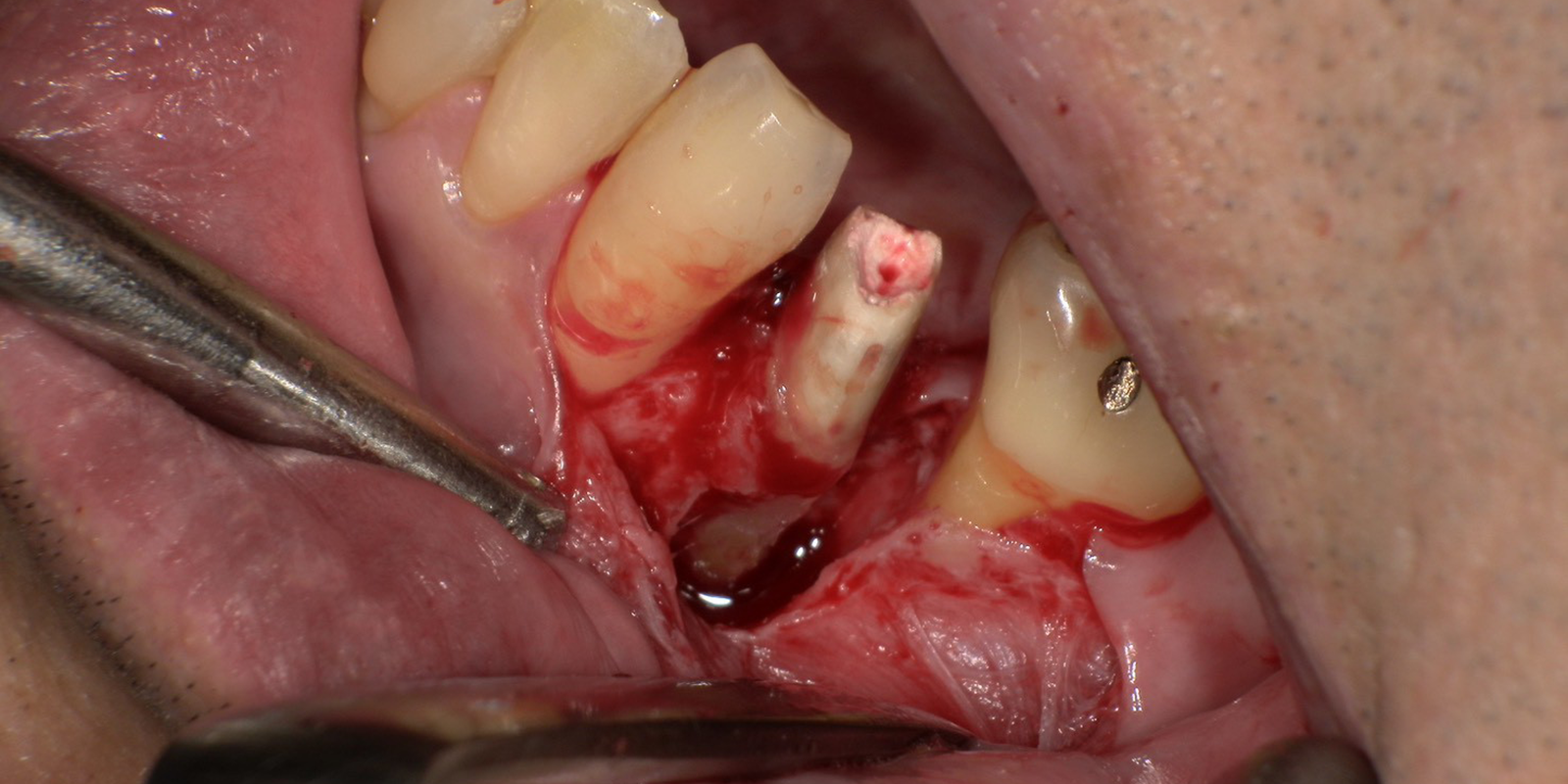 外科的にお掃除