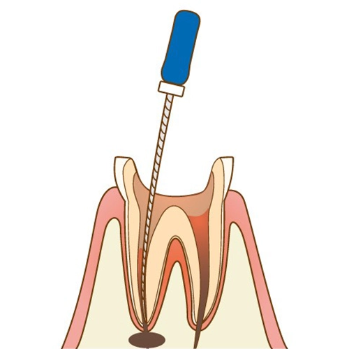 治療法について
