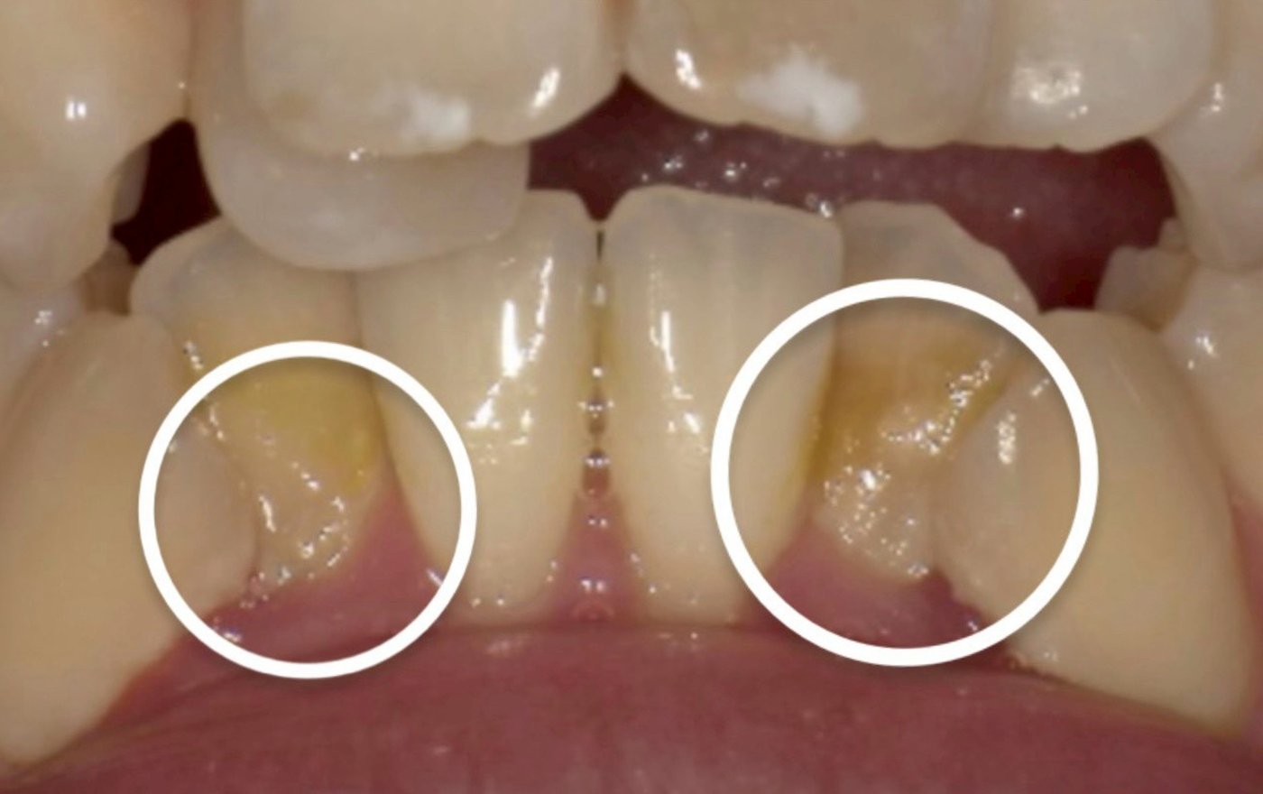 みなさんは歯垢と歯石の違いは分かりますか？