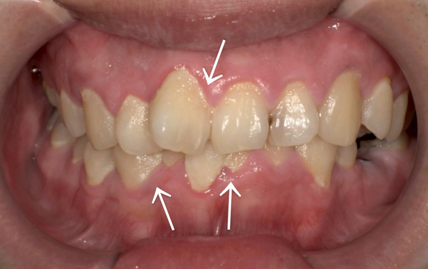 みなさんは歯垢と歯石の違いは分かりますか？