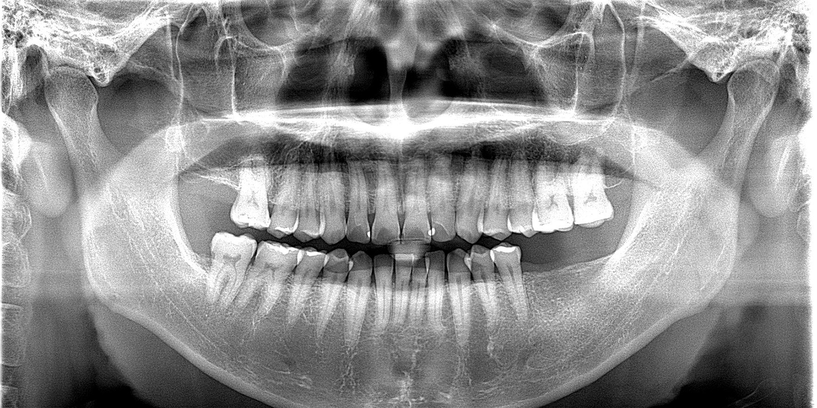 左下インプラント埋入のケース