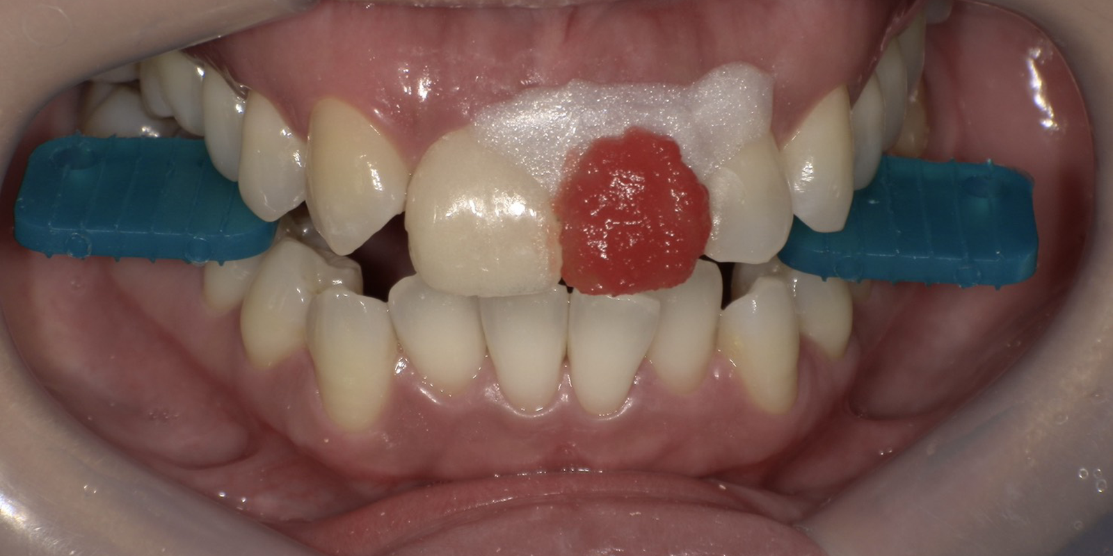 左上1：ウォーキングブリーチ・右上1：仮歯