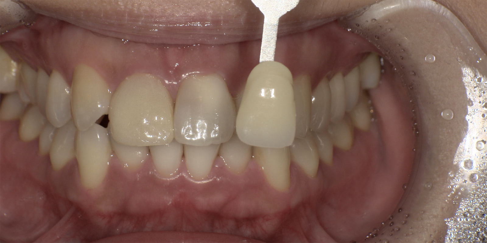 ウォーキングブリーチ術前術後