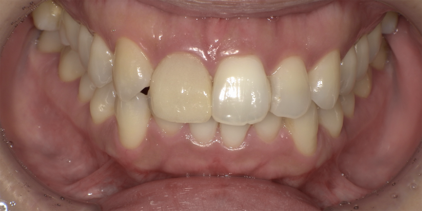 ウォーキングブリーチ術前術後