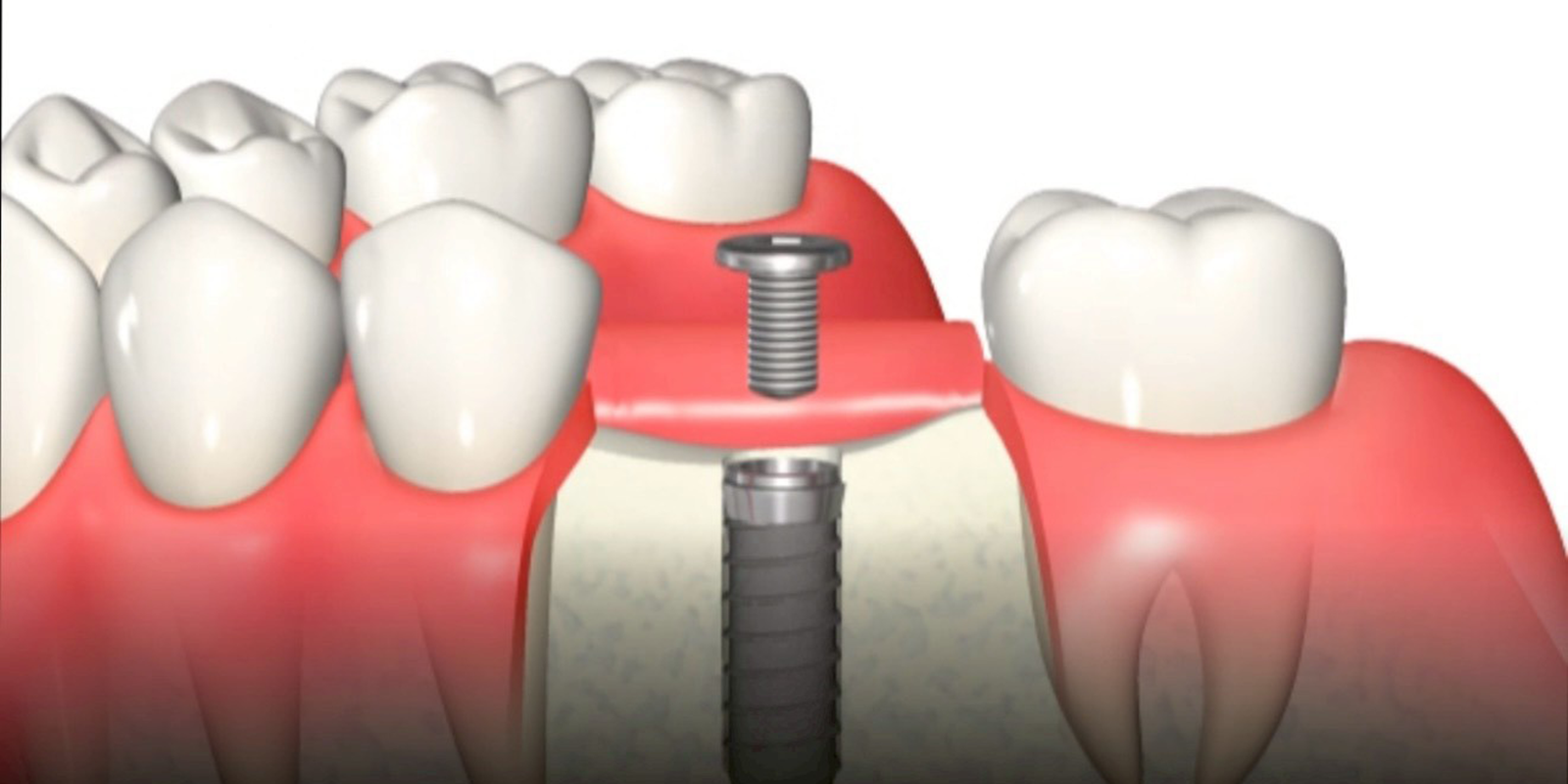 インプラント体(フィクスチャー)埋入窩の形成