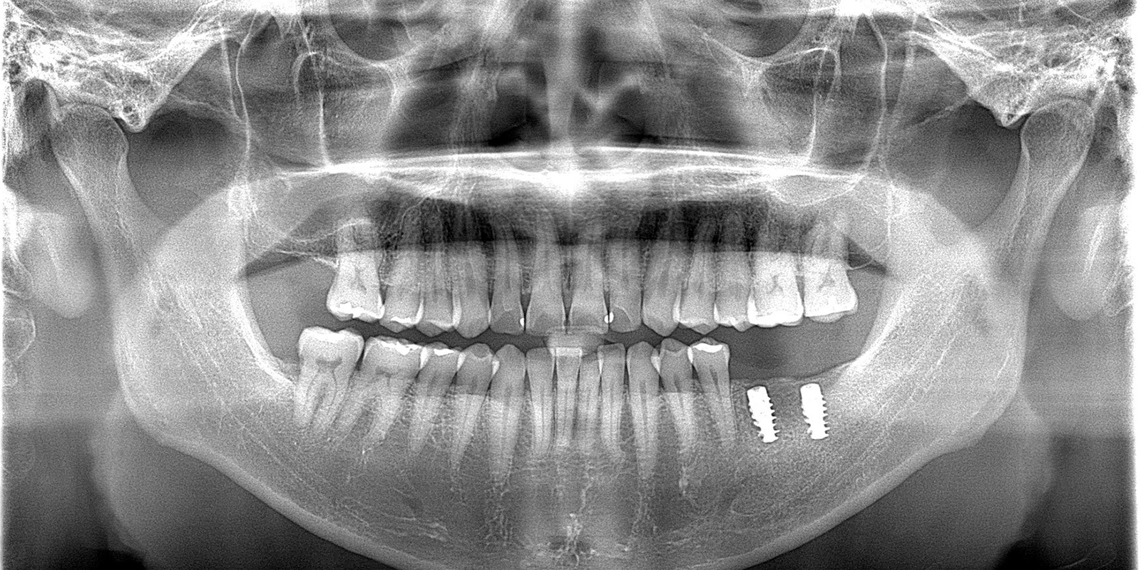 術後のレントゲン写真