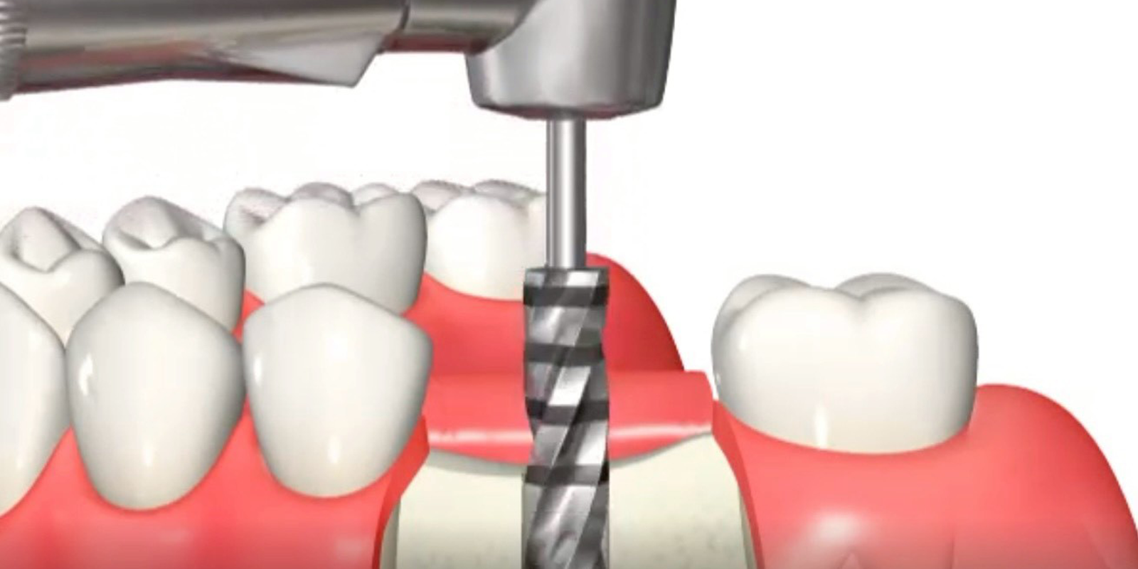 インプラント体(フィクスチャー)埋入窩の形成