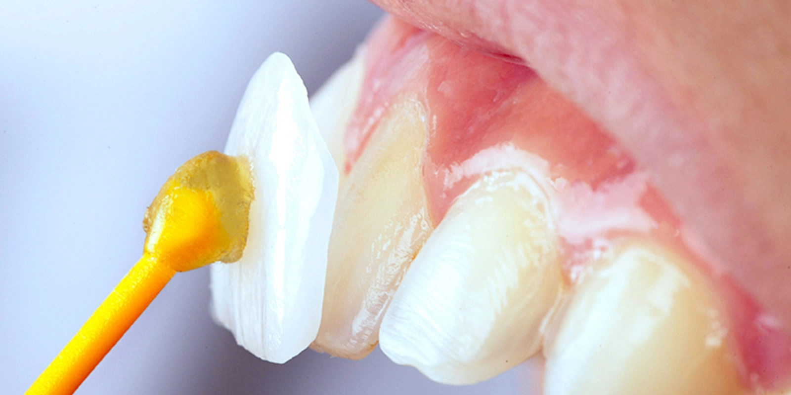 ラミネートベニア