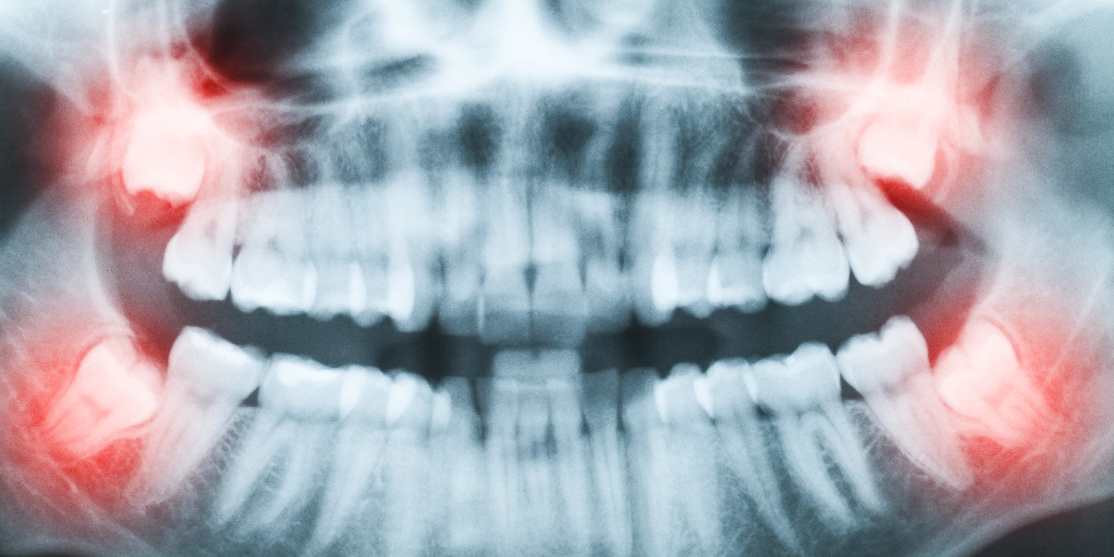 親知らずとは何か、なぜ問題を起こすのか