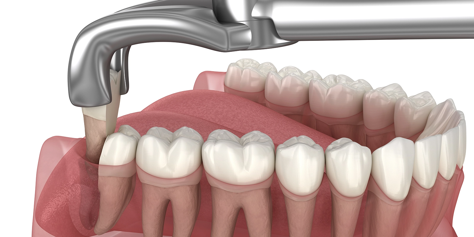 抜歯の手順と術中の工夫