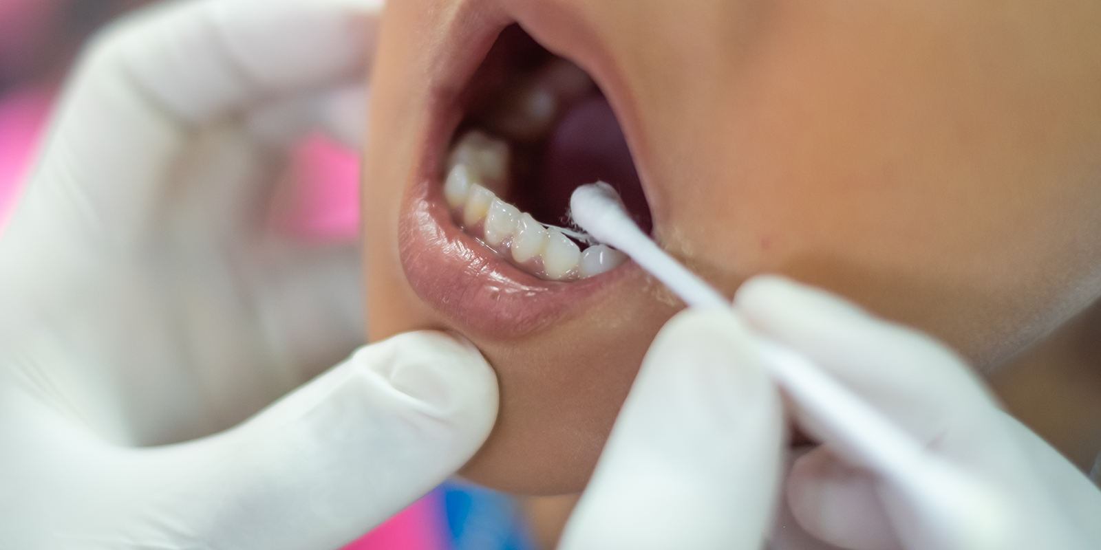 フッ素塗布の種類と適切な時期