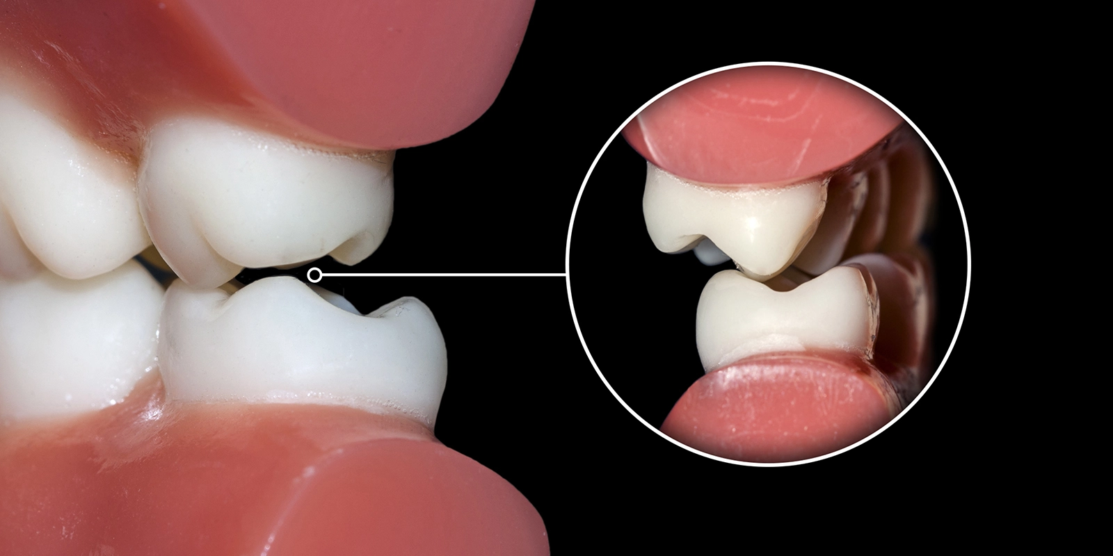 歯ぎしりを放置した場合のリスク