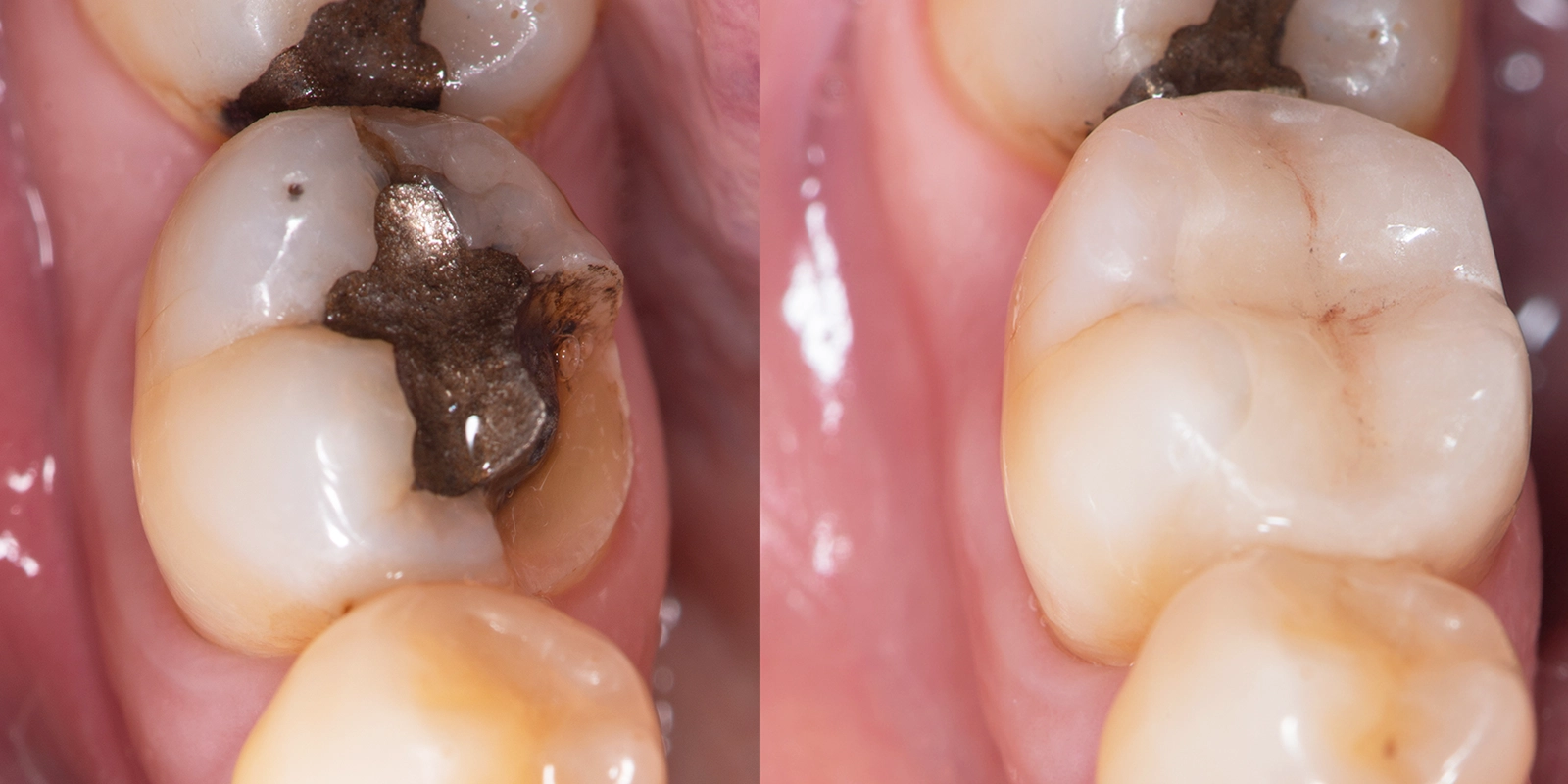 セラミックと金属の比較