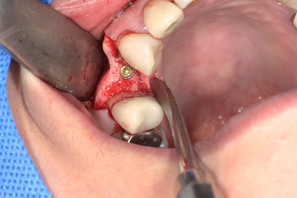 メスを用いてインプラント体埋入部に歯槽頂切開を加える