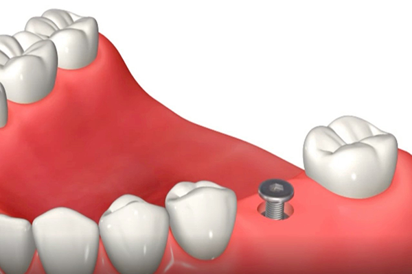 フィクスチャーに装着してあるカバースクリューを外す
