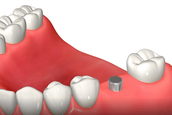 フィクスチャーにヒーリングアバットメントを装着し縫合する