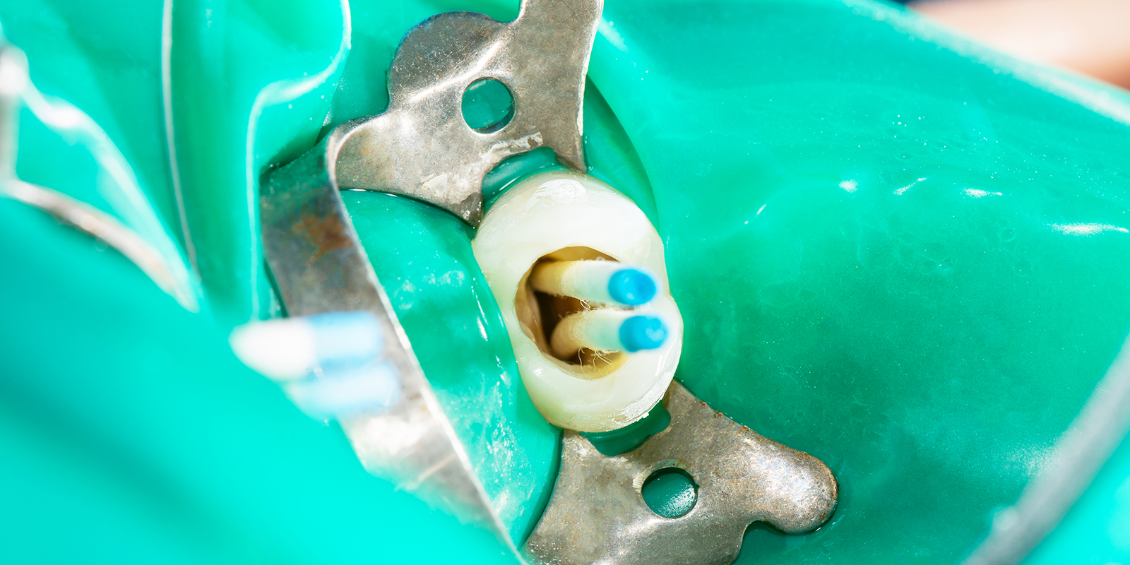 ラバーダム防湿とは？